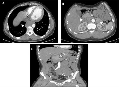 Case Report: Pheochromocytoma and Synchronous Neuroblastoma in a Family With Hereditary Pheochromocytoma Associated With a MAX Deleterious Variant